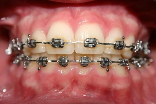 Épisode Chablis Hebdo // Évitez les appareils dentaires de l'émission Chablis Hebdo