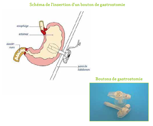 Schéma de l'insertion d'un bouton de gastrostomie
